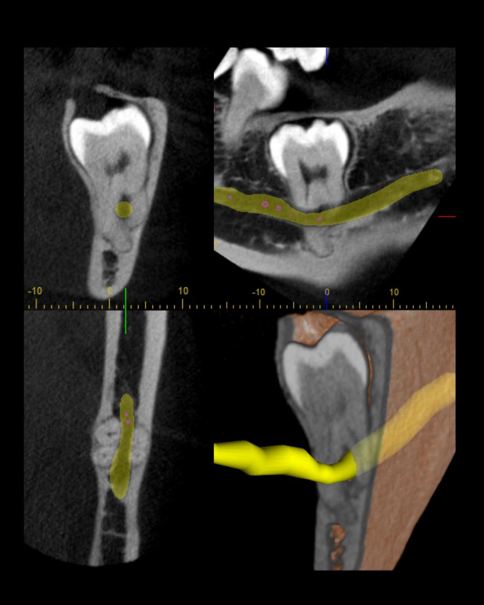 CONE BEAM